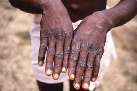 US Case Adds to Unusual Monkeypox Outbreak